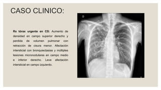 Rx tórax urgente en CS: Aumento de
densidad en campo superior derecho y
perdida de volumen pulmonar con
retracción de cisura menor. Afectación
intersticial con bronquiectasias y múltiples
lesiones micronodulares en campo medio
e inferior derecho. Leve afectación
intersticial en campo izquierdo.
CASO CLINICO:
 