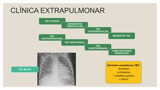 CLÍNICA EXTRAPULMONAR
TBC PLEURAL
LINFADENITIS
TUBERCULOSA
TBC
OSTEOARTICULAR
MENINGITIS TBC
TBC
GASTROINTESTINAL
TBC PERICÁRDICA
TBC
GENITOURINARIA
COMPLICACIONES
RESIDUALES
Derrames causados por TBC:
•Exudados
•Linfocitarios
•↑ Interferon gamma
•↑ ADA-2
TBC MILIAR
 