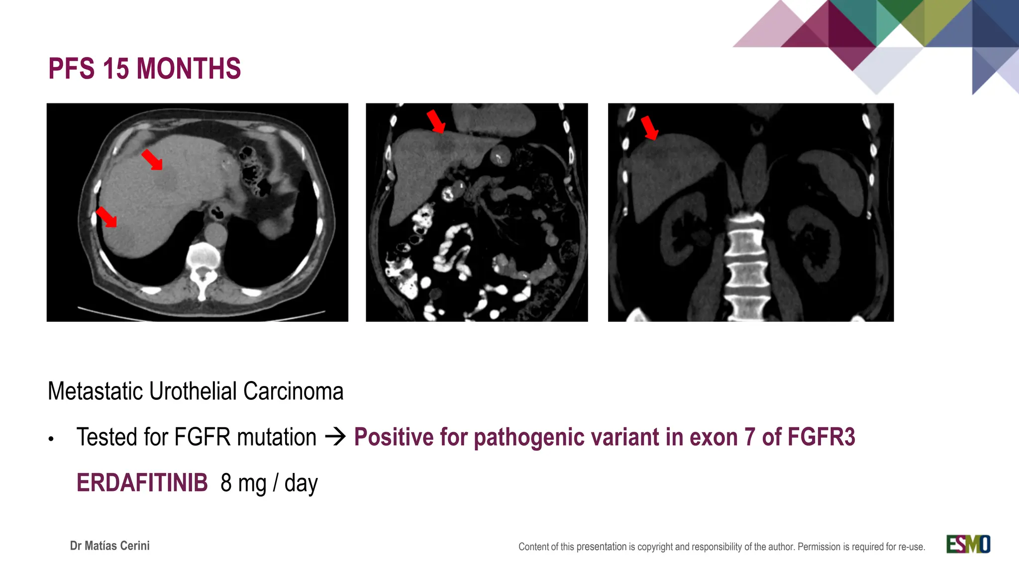 Metastatic Urothelial Carcinoma get details about it | PDF