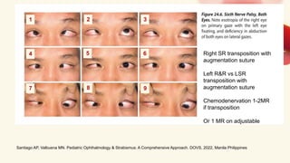 Strabismus Surgeries for Cranial Nerve Palsies | PDF