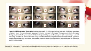 Strabismus Surgeries for Cranial Nerve Palsies | PDF