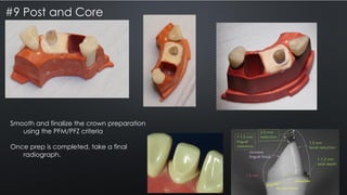 Dental endodontic treated teeth post and cores | PDF