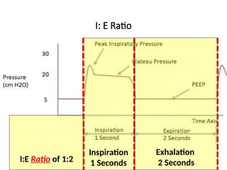 ZOLL Medical
I: E Ratio
Inspiration
1 Seconds
Exhalation
2 Seconds
I:E Ratio of 1:2
 
