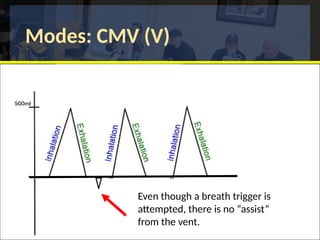 Modes: CMV (V)
Even though a breath trigger is
attempted, there is no “assist”
from the vent.
 