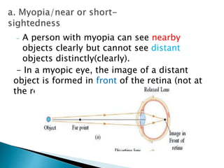 - A person with myopia can see nearby
objects clearly but cannot see distant
objects distinctly(clearly).
- In a myopic eye, the image of a distant
object is formed in front of the retina (not at
the retina).
 