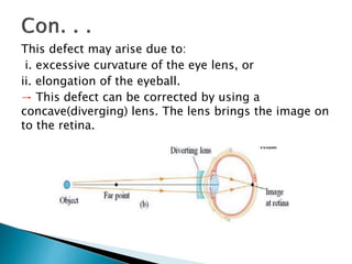 This defect may arise due to:
i. excessive curvature of the eye lens, or
ii. elongation of the eyeball.
→ This defect can be corrected by using a
concave(diverging) lens. The lens brings the image on
to the retina.
 