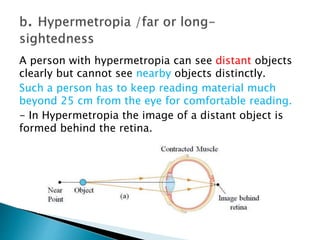 A person with hypermetropia can see distant objects
clearly but cannot see nearby objects distinctly.
Such a person has to keep reading material much
beyond 25 cm from the eye for comfortable reading.
- In Hypermetropia the image of a distant object is
formed behind the retina.
 