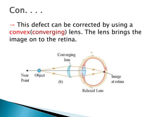 → This defect can be corrected by using a
convex(converging) lens. The lens brings the
image on to the retina.
 