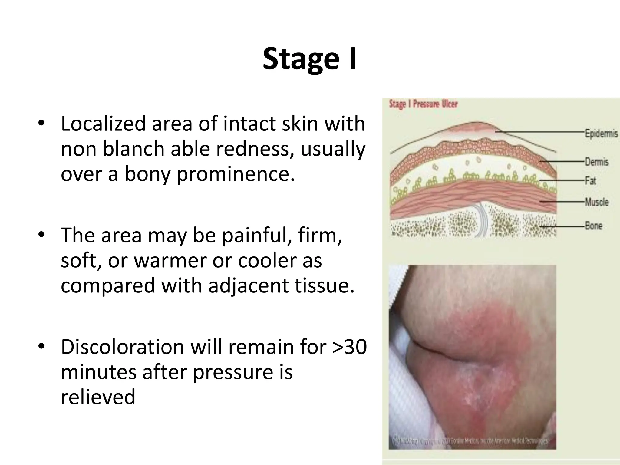 Pressure Ulcers A Decubitus Ulcer Stages Of Bedsore PDF