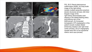 FIG. 28.31 Renal arteriovenous
malformation (AVM). (A) Gray-scale
image of the right kidney
reveals multiple serpentine anechoic
tubular structures (arrows). (B) Color
Doppler image of the
right kidney demonstrates color
aliasing in the dilated feeding artery
and draining vein of the
AVM (arrow). (C) Computed
tomographic (CT) angiography in this
patient reveals multiple dilated
enhancing vessels in the right renal
cortex (arrows). (D) CT angiography
reveals early fill-in of he suprarenal
inferior vena cava (arrows)
 