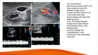FIG. 28.32 Renal
arteriovenous fistula (AVF). (A)
Gray-scale and color (B)
Doppler images show
a cystic structure (arrow in A)
in the renal hilum that
demonstrates color flow with
aliasing (arrow
in B). (C) Pulsed Doppler
images show high-velocity,
low-resistance flow in the
feeding artery
and (D) pulsatile flow
(“arterialization”) and
turbulence in the associated
renal vein.
 