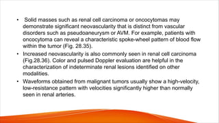 • Solid masses such as renal cell carcinoma or oncocytomas may
demonstrate significant neovascularity that is distinct from vascular
disorders such as pseudoaneurysm or AVM. For example, patients with
oncocytoma can reveal a characteristic spoke-wheel pattern of blood flow
within the tumor (Fig. 28.35).
• Increased neovascularity is also commonly seen in renal cell carcinoma
(Fig.28.36). Color and pulsed Doppler evaluation are helpful in the
characterization of indeterminate renal lesions identified on other
modalities.
• Waveforms obtained from malignant tumors usually show a high-velocity,
low-resistance pattern with velocities significantly higher than normally
seen in renal arteries.
 