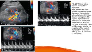 FIG. 28.17 Renal artery
stenosis in one of two
duplicated
renal arteries. (A) Color
Doppler image shows similar
diameter of the duplicated
left renal arteries. (B) Pulsed
Doppler interrogation of the
superior duplicated renal
artery (LRA 1) shows peak
systolic velocity (PSV) of
120 cm/s. (C) Elevated PSVs
of 202 cm/s are noted at the
midportion of the second
duplicated left renal artery
(LRA 2). DECUB, Decubital;
LK, left kidney
 