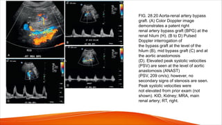 FIG. 28.20 Aorta-renal artery bypass
graft. (A) Color Doppler image
demonstrates a patent right
renal artery bypass graft (BPG) at the
renal hilum (H). (B to D) Pulsed
Doppler interrogation of
the bypass graft at the level of the
hilum (B), mid bypass graft (C) and at
the aortic anastomosis
(D). Elevated peak systolic velocities
(PSV) are seen at the level of aortic
anastomosis (ANAST)
(PSV, 209 cm/s); however, no
secondary signs of stenosis are seen.
Peak systolic velocities were
not elevated from prior exam (not
shown). KID, Kidney; MRA, main
renal artery; RT, right.
 
