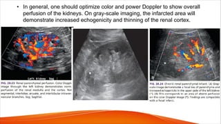 • In general, one should optimize color and power Doppler to show overall
perfusion of the kidneys. On gray-scale imaging, the infarcted area will
demonstrate increased echogenicity and thinning of the renal cortex.
 