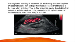 • The diagnostic accuracy of ultrasound for renal artery occlusion depends
on reasonable color flow and spectral Doppler sensitivity at the level of
the renal artery or kidney. That is, flow should be readily detected in other
vessels at a similar depth or in the contralateral kidney before one can
definitively state that a renal artery is occluded
 
