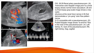 FIG. 28.29 Renal artery pseudoaneurysm. (A)
Transverse color Doppler image prior to a renal
biopsy shows normal renal vasculature. (B and
C) Post biopsy gray-scale image shows a new
cystic
structure at the renal hilum (arrow in B) that
demonstrates a “yin-yang” color flow pattern
(arrow
in C) compatible with a pseudoaneurysm. (D)
Pulsed Doppler image shows “to-and-fro” flow
in the neck of the pseudoaneurysm. LK, Left
kidney; N, neck of the pseudoaneurysm; RK,
right kidney; Sag, sagittal
 