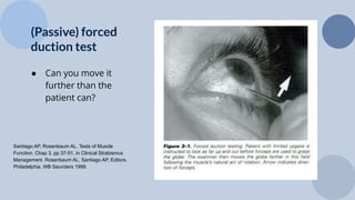 Diplopia After Cataract and Retina Surgery (in a mature visual system ...