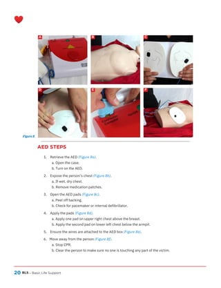 20
AED STEPS
BLS
A
D
B
E
C
F
– Basic Life Support
1. Retrieve the AED (Figure 8a).
a. Open the case.
b. Turn on the AED.
2. Expose the person’s chest (Figure 8b).
a. If wet, dry chest.
b. Remove medication patches.
3. Open the AED pads (Figure 8c).
a. Peel off backing.
b. Check for pacemaker or internal defibrillator.
4. Apply the pads (Figure 8d).
a. Apply one pad on upper right chest above the breast.
b. Apply the second pad on lower left chest below the armpit.
5. Ensure the wires are attached to the AED box (Figure 8e).
6. Move away from the person (Figure 8f).
a. Stop CPR.
b. Clear the person to make sure no one is touching any part of the victim.
Figure 8
 