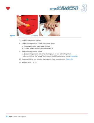21 BLS
G H
– Basic Life Support
(Figure 8g).
7. Let AED analyze the rhythm.
9. If AED message reads “Shock,”
a. Be sure the person is “clear” by making sure no one is touching them.
b. Press and hold the “shock” button until the AED delivers the shock
11. Repeat steps 1 to 10.
10. Resume CPR for two minutes starting with chest compressions .
(Figure 8h)
8. If AED message reads “Check Electrodes,” then:
a. Ensure electrodes make good contact.
b. If chest is hairy, pull off pad and replace it.
Figure 8
USE OF AUTOMATED
EXTERNAL DEFIBRILLATOR
3
 