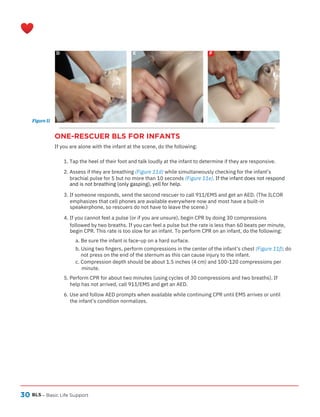 30
ONE-RESCUER BLS FOR INFANTS
If you are alone with the infant at the scene, do the following:
BLS
D E F
– Basic Life Support
1. Tap the heel of their foot and talk loudly at the infant to determine if they are responsive.
2. Assess if they are breathing (Figure 11d) while simultaneously checking for the infant’s
brachial pulse for 5 but no more than 10 seconds (Figure 11e). If the infant does not respond
and is not breathing (only gasping), yell for help.
3. If someone responds, send the second rescuer to call 911/EMS and get an AED. (The ILCOR
emphasizes that cell phones are available everywhere now and most have a built-in
speakerphone, so rescuers do not have to leave the scene.)
4. If you cannot feel a pulse (or if you are unsure), begin CPR by doing 30 compressions
followed by two breaths. If you can feel a pulse but the rate is less than 60 beats per minute,
begin CPR. This rate is too slow for an infant. To perform CPR on an infant, do the following:
a. Be sure the infant is face-up on a hard surface.
b. Using two fingers, perform compressions in the center of the infant’s chest (Figure 11f); do
not press on the end of the sternum as this can cause injury to the infant.
c. Compression depth should be about 1.5 inches (4 cm) and 100-120 compressions per
minute.
5. Perform CPR for about two minutes (using cycles of 30 compressions and two breaths). If
help has not arrived, call 911/EMS and get an AED.
6. Use and follow AED prompts when available while continuing CPR until EMS arrives or until
the infant’s condition normalizes.
Figure 11
 