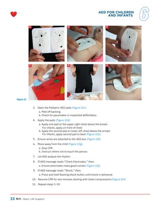 33 BLS
C
F G
D
H
E
– Basic Life Support
.
(Figure 12h)
Figure 12
AED FOR CHILDREN
AND INFANTS
6
3. Open the Pediatric AED pads (Figure 12c).
a. Peel off backing.
b. Check for pacemaker or implanted defibrillator.
4. Apply the pads (Figure 12d).
a. Apply one pad on the upper right chest above the breast.
For infants, apply on front of chest
b. Apply the second pad on lower left chest below the armpit.
For infants, apply second pad to back (Figure 12e).
5.
6. Move away from the child (Figure 12g).
a. Stop CPR.
b. Instruct others not to touch the person.
7. Let AED analyze the rhythm.
8. If AED message reads “Check Electrodes,” then:
a. Ensure electrodes make good contact (Figure 12f).
9. If AED message reads “Shock,” then:
a. Press and hold flashing shock button until shock is delivered.
10. Resume CPR for two minutes starting with chest compressions
11. Repeat steps 1-10.
Ensure wires are attached to the AED box (Figure 12f).
 