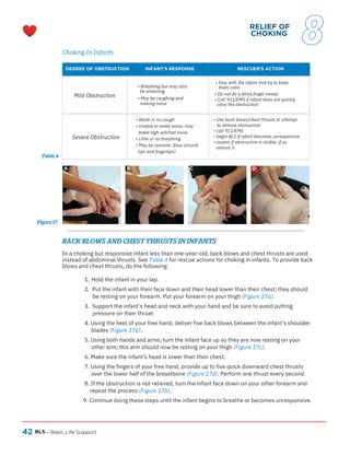 42 BLS
A B C D
– Basic Life Support
Choking In Infants
DEGREE OF OBSTRUCTION INFANT’S RESPONSE RESCUER’S ACTION
Mild Obstruction
Severe Obstruction
In a choking but responsive infant less than one-year-old, back blows and chest thrusts are used
instead of abdominal thrusts. See Table 4 for rescue actions for choking in infants. To provide back
blows and chest thrusts, do the following:
Hold the infant in your lap.
1.
2. Put the infant with their face down and their head lower than their chest; they should
be resting on your forearm. Put your forearm on your thigh (Figure 17a).
3. Support the infant’s head and neck with your hand and be sure to avoid putting
pressure on their throat.
4. Using the heel of your free hand, deliver five back blows between the infant’s shoulder
blades (Figure 17b).
5. Using both hands and arms, turn the infant face up so they are now resting on your
other arm; this arm should now be resting on your thigh (Figure 17c).
6. Make sure the infant’s head is lower than their chest.
7. Using the fingers of your free hand, provide up to five quick downward chest thrusts
over the lower half of the breastbone (Figure 17d). Perform one thrust every second.
8. If the obstruction is not relieved, turn the infant face down on your other forearm and
repeat the process (Figure 17b).
9. Continue doing these steps until the infant begins to breathe or becomes unresponsive.
• Breathing but may also
be wheezing
• May be coughing and
making noise
• Weak or no cough
• Unable to make noise; may
make high-pitched noise
• Little or no breathing
• May be cyanotic (blue around
lips and fingertips)
• Stay with the infant and try to keep
them calm
• Do not do a blind finger sweep
• Call 911/EMS if infant does not quickly
clear the obstruction
• Use back blows/chest thrusts to attempt
to remove obstruction
• call 911/EMS
• begin BLS if infant becomes unresponsive
• assess if obstruction is visible; if so,
remove it
BACK BLOWS AND CHEST THRUSTS IN INFANTS
Figure 17
Table 4
RELIEF OF
CHOKING
8
 