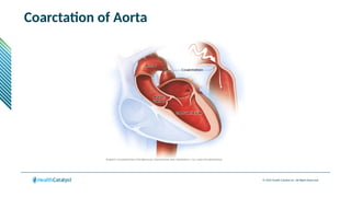 © 2024 Health Catalyst Inc. All Rights Reserved.
Coarctation of Aorta
 
