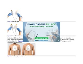 Figure 16. Child AED pads.
Figure 17. Adult AED pads.
Follow the AED manufacturer’s instructions for pad placement and weight recommendations. Illustrations are located on the
pads. Weight recommendations will be located on the packaging. Some AEDs require that child pads be placed in a front and
back (AP) position (Figure 18), while others require right-left (anterolateral) placement (Figure 19). AP pad placement is
commonly used for infants.
Figure 18. AP AED pad placement on a child.
 