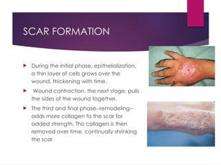 2025 Scar management and Pressure Garments.pptx