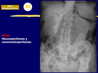 PRxA:
Neumoperitoneo y
neumoretroperitoneo
Mini
diagnósticos 28
 
