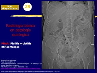 PRxA: Pielitis y cistitis
enfisematosa
Mini
diagnósticos 29
Radiología básica
en patología
quirúrgica
Bibliografía recomendada:
Motta-Ramirez GA et al.
Pielonefritis enfisematosa. Estudios radiológicos y de imagen (US y TC)
para su diagnóstico y manejo.
Acta Médica Grupo Ángeles 2014;12(1):5-12.
https://www.medigraphic.com/pdfs/actmed/am-2014/am141a.pdf
https://www.slideshare.net/slideshow/casos-pielonefritis-enfisematosa-archivo-historico/33032210
 