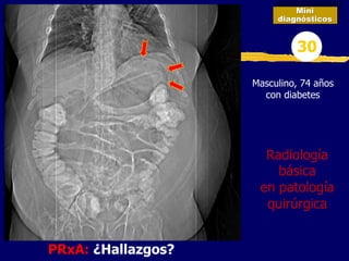 PRxA: ¿Hallazgos?
Mini
diagnósticos
30
Radiología
básica
en patología
quirúrgica
Masculino, 74 años
con diabetes
 