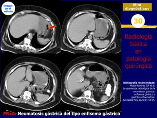 Mini
diagnósticos
30
Radiología
básica
en
patología
quirúrgica
PRxA: Neumatosis gástrica del tipo enfisema gástrico
Bibliografía recomendada:
Motta-Ramírez GA et al.
La apariencia radiológica de la
neumatosis gástrica:
enfisema gástrico o
gastritis enfisematosa.
An Radiol Mex 2025;24:43-55.
Imagen
en el
articulo
 