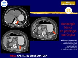 Mini
diagnósticos
31
Radiología
básica
en patología
quirúrgica
PRxA: GASTRITIS ENFISEMATOSA
Bibliografía recomendada:
Motta-Ramírez GA et al.
La apariencia radiológica de la
neumatosis gástrica:
enfisema gástrico o
gastritis enfisematosa.
An Radiol Mex 2025;24:43-55.
Caso 2
del
articulo
 