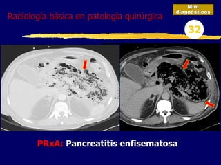 PRxA: Pancreatitis enfisematosa
Mini
diagnósticos
32
Radiología básica en patología quirúrgica
 