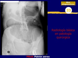 PRxA: Patrón aéreo
Mini
diagnósticos
33
Radiología básica
en patología
quirúrgica
 