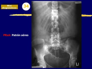 PRxA: Patrón aéreo
Mini
diagnósticos 34
 