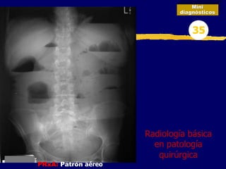 PRxA: Patrón aéreo
Mini
diagnósticos
35
Radiología básica
en patología
quirúrgica
 