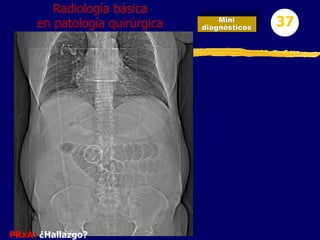 Mini
diagnósticos 37
Radiología básica
en patología quirúrgica
PRxA: ¿Hallazgo?
 