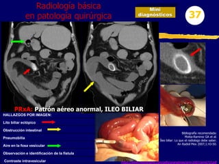 Mini
diagnósticos 37
Radiología básica
en patología quirúrgica
HALLAZGOS POR IMAGEN:
Lito biliar ectópico
Obstrucción intestinal
Pneumobilia
Aire en la fosa vesicular
Observación e identificación de la fístula
Contraste intravesicular
Bibliografía recomendada:
Motta-Ramirez GA et al.
Íleo biliar: Lo que el radiologo debe saber.
An Radiol Mex 2007;1:43-50.
https://www.medigraphic.com/pdfs/anaradmex/arm-2007/arm071f.pdf
PRxA: Patrón aéreo anormal, ILEO BILIAR
 