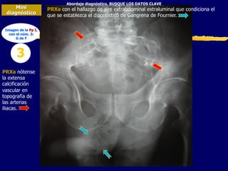 Abordaje diagnóstico, BUSQUE LOS DATOS CLAVE
Mini
diagnóstico
3
PRXa con el hallazgo de aire extrabdominal extraluminal que condiciona el
que se establezca el diagnóstico de Gangrena de Fournier.
PRXa nótense
la extensa
calcificación
vascular en
topografía de
las arterias
iliacas.
Imagen de la Pp I,
con el núm. 3:
G de F
 