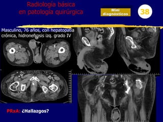 Mini
diagnósticos 38
Radiología básica
en patología quirúrgica
PRxA: ¿Hallazgos?
Masculino, 76 años, con hepatopatía
crónica, hidronefrosis izq. grado IV
 