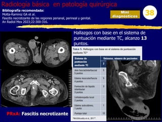Mini
diagnósticos
38
Radiología básica en patología quirúrgica
PRxA: Fascitis necrotizante
Hallazgos con base en el sistema de
puntuación mediante TC, alcanzo 13
puntos.
Bibliografía recomendada:
Motta-Ramirez GA et al.
Fascitis necrotizante de las regiones perianal, perineal y genital.
An Radiol Mex 2023;22:300-316.
 
