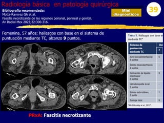 Mini
diagnósticos
39
Radiología básica en patología quirúrgica
Femenina, 57 años; hallazgos con base en el sistema de
puntuación mediante TC, alcanzo 9 puntos.
Bibliografía recomendada:
Motta-Ramirez GA et al.
Fascitis necrotizante de las regiones perianal, perineal y genital.
An Radiol Mex 2023;22:300-316.
PRxA: Fascitis necrotizante
 