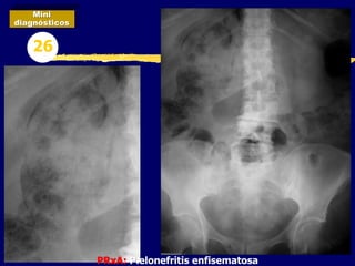PRxA: Pielonefritis enfisematosa
Mini
diagnósticos
26
 