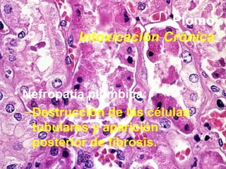 Plomo Intoxicación Crónica <ul><li>Nefropatía plúmbica: </li></ul><ul><ul><li>Destrucción de las células tubulares y apari...