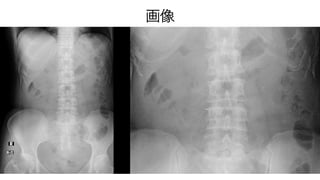 急性腹症のCT | PPTX