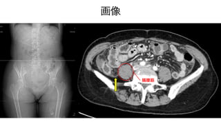 急性腹症のCT | PPTX