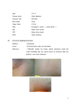 3
Suhu : 37,8 ˚C
Tekanan darah : Tidak dilakukan
Frekuensi nadi : 80x/menit
Berat badan : 20 kg
Tinggi badan : 110 cm
Mata : Konjungtiva anemis -/-, sklera ikterik -/-
Gigi : Dalam batas normal
THT : Dalam batas normal
KGB : Tidak membesar
IV. STATUS DERMATOLOGI
Distribusi : Generalisata
Lokasi : Di daerah badan, muka dan ekstremitas
Efloresensi : Polimorfik, tampak lesi berupa makula eritematosa terdiri dari
vesikel berdinding tipis dan seperti tetesan air berukuran milier dan
lentikuler serta krusta kehitaman.
 